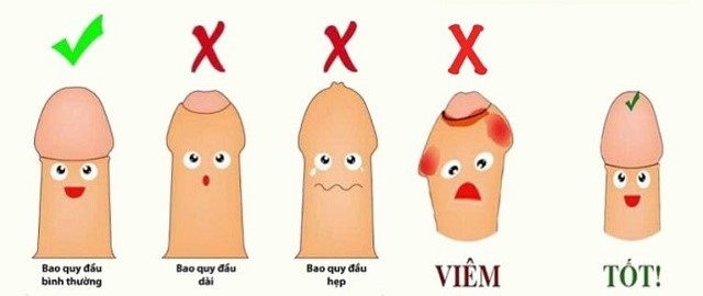 Cắt bao quy đầu tốt nhất Hải Phòng