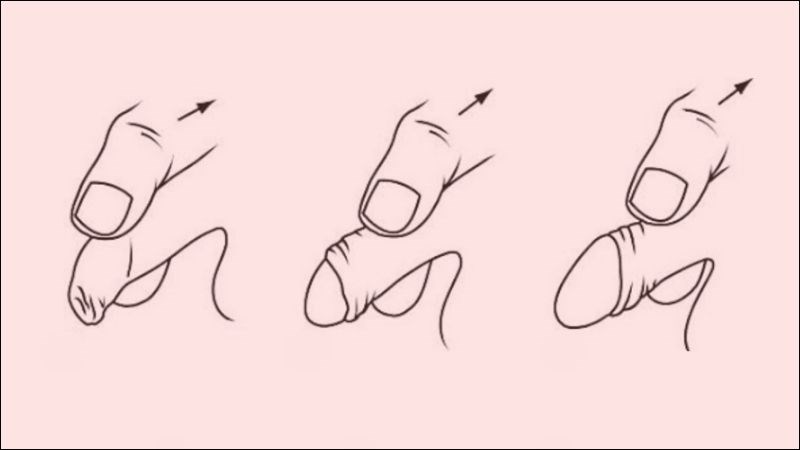 Phòng khám chữa dài bao quy đầu Hải Phòng