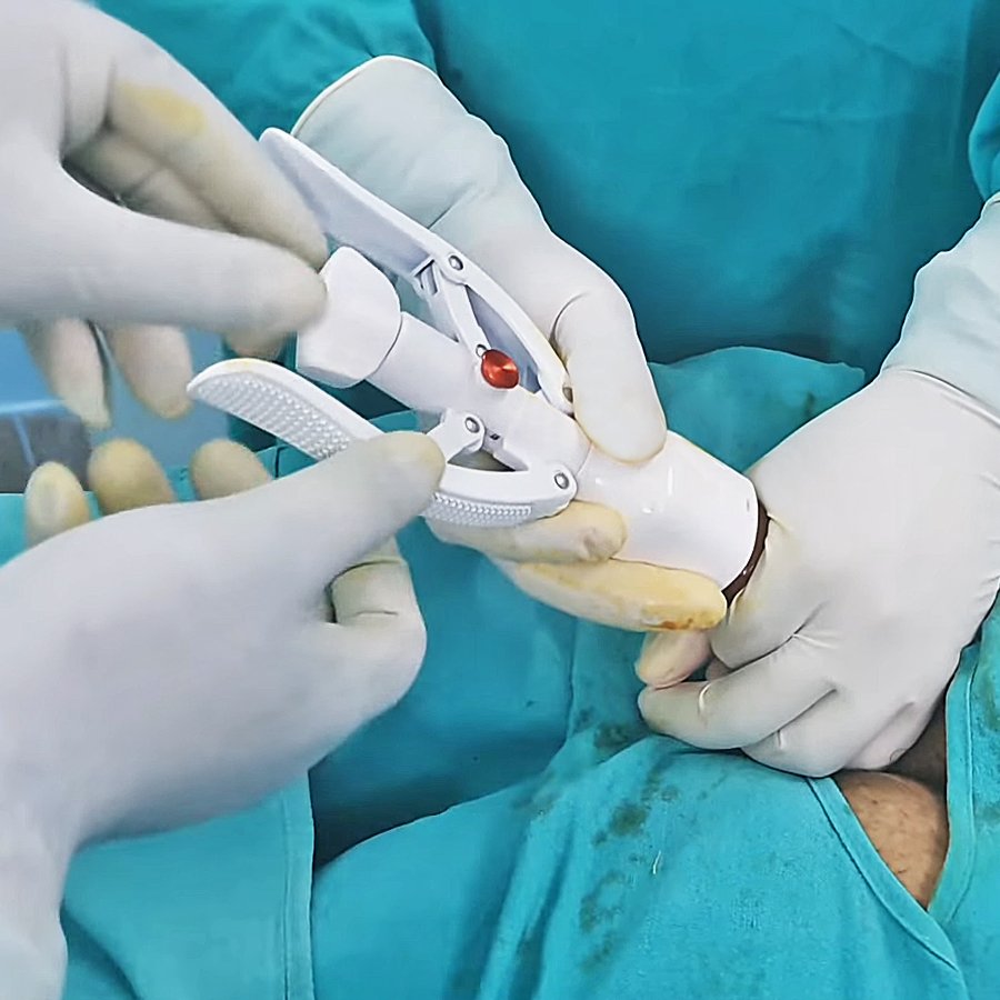 Thủ thuật cắt bao quy đầu an toàn tại Hải Phòng