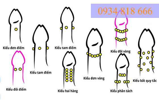 Gắn bi vào dương vật ở Hải Phòng