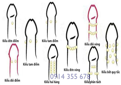 Cấy bi cho nam giới tại Hải Phòng