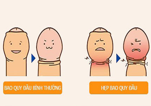 Nghẹt bao quy đầu Hải Phòng